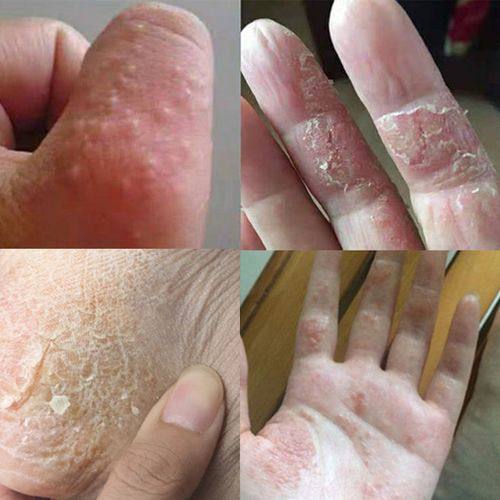 一抹恢复手痒水泡手脱皮干裂手气膏手上起小水泡止痒膏起皮等问题