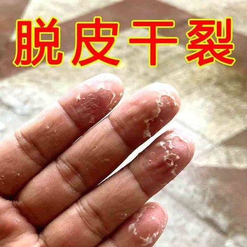 手脱皮护手修复霜季节性手掌干裂手指头起水泡痒手掌开裂蜕皮起皮