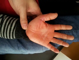 手脱皮修复霜手指头爆皮起皮干燥手掌褪皮掉皮干裂脚底蜕皮季节性