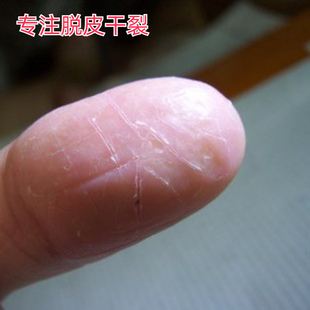 手指头裂口子干裂修复护手霜开裂脱皮裂开手足开口手脚冬季皲裂膏