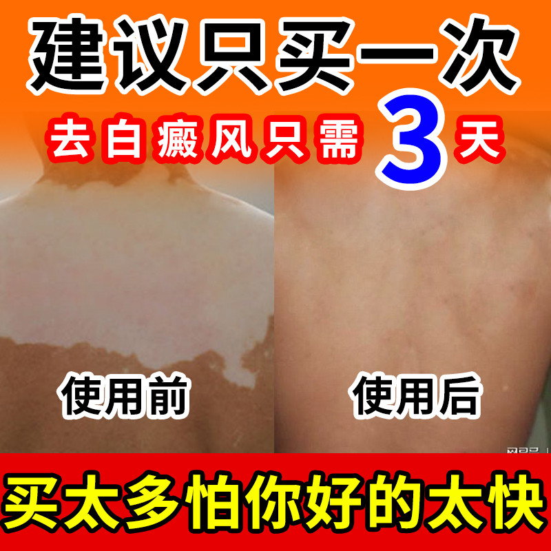 外用快速消白斑专用补骨脂酊特效黑色素生长软膏遮盖神器