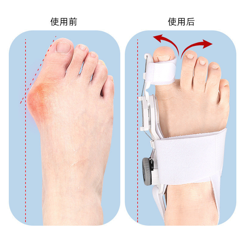 大拇指外翻矫形器大脚骨突出重叠趾分离器日夜用旋钮可调矫形器