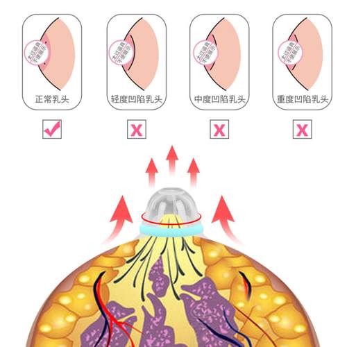 孕产专用乳头矫正牵引器