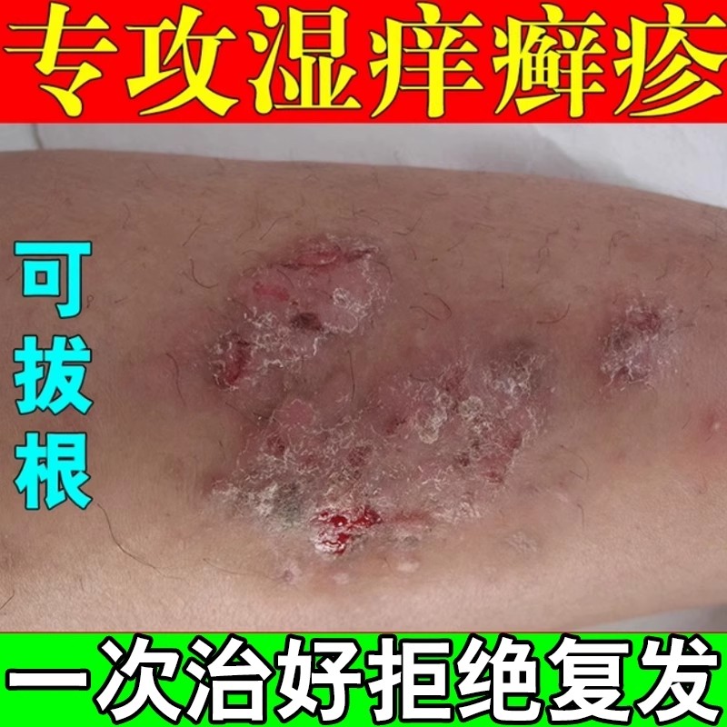 神经性皮炎去湿痒疹真菌感染慢性保健理疗
