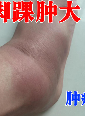 脚踝肿大疼崴脚扭伤恢复膏药脚踝韧带损伤撕裂专用拉跌打损伤膏贴