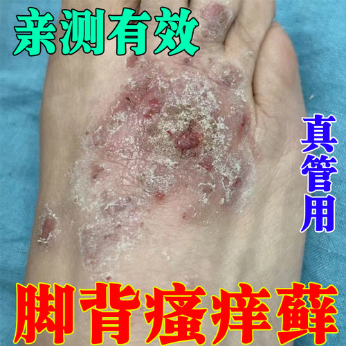 治疗脚背痒面脚趾头上长脱藓屑疙瘩起红疹子干燥起痒皮肤药专用