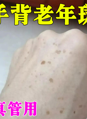 手上斑点老年斑强力去除手上手部手背晒黑斑黄褐斑淡化黑色素沉淀