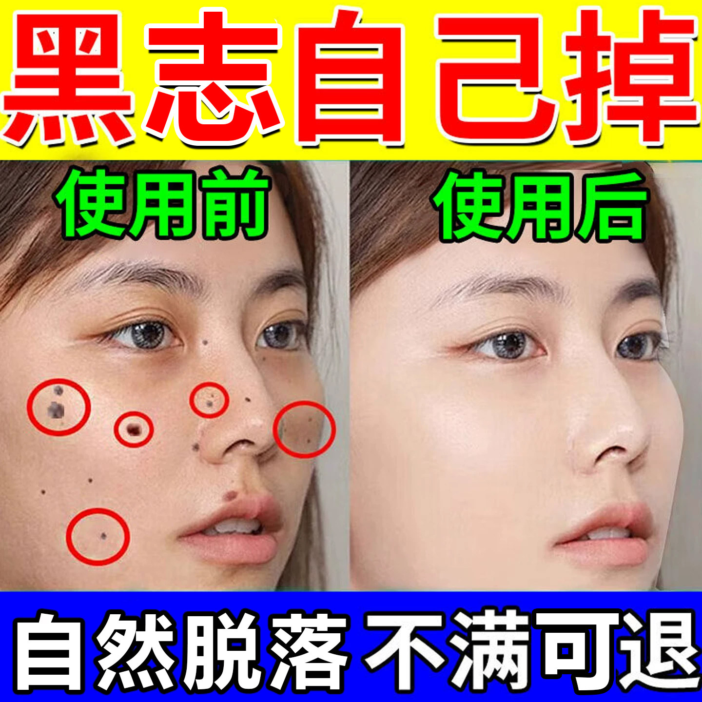点痣膏无痕点斑疙粒志脸部专用去痣瘩不留疤官方正品去脸上去肉除