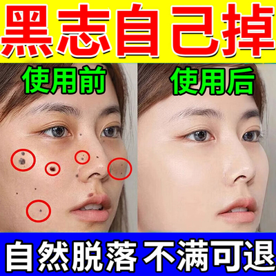 点痣膏无痕点斑疙粒志脸部专用去痣瘩不留疤官方正品去脸上去肉除