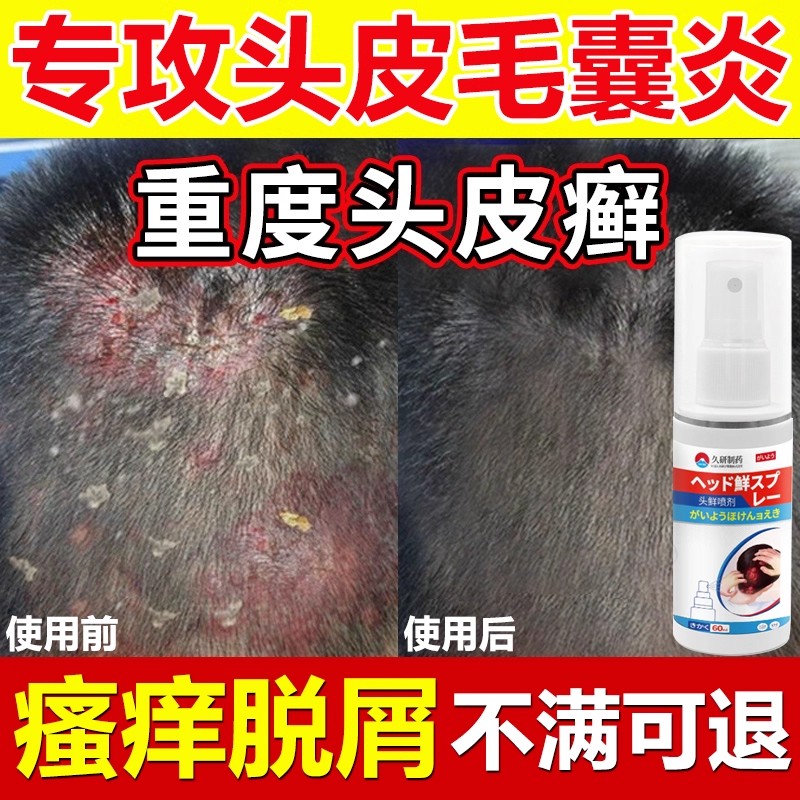 头皮癣专用去毛囊痒脂溢性菌皮焱疙瘩杀皮藓专用炎喷雾剂正品