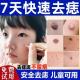 点痣膏无痕点斑疙瘩志脸部专用去痣不留疤正品 旗舰店脸上肉粒去除