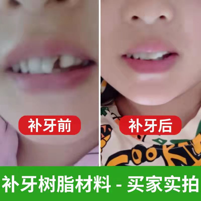 牙缝填充神器假牙套牙仿真补牙齿缝隙大缺牙临时牙套牙贴遮盖门牙