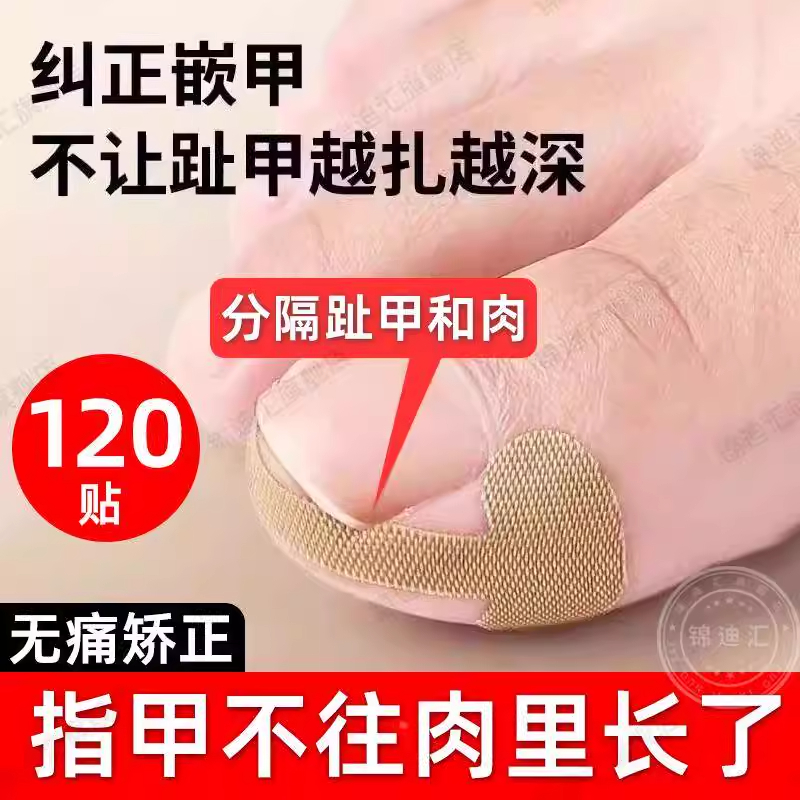 甲沟神器指甲矫正器嵌甲专用