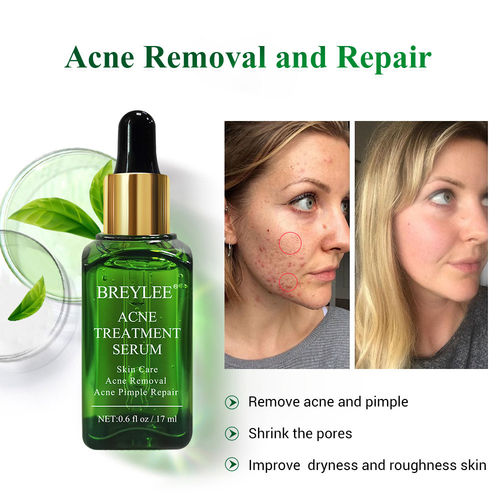 Tea Tree Acne Solution Kit Acne Treatment cream茶树套装