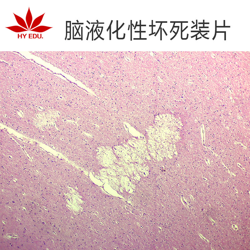【红叶】高教病理类组织标本生物切片脑液化性坏死切片成像清晰