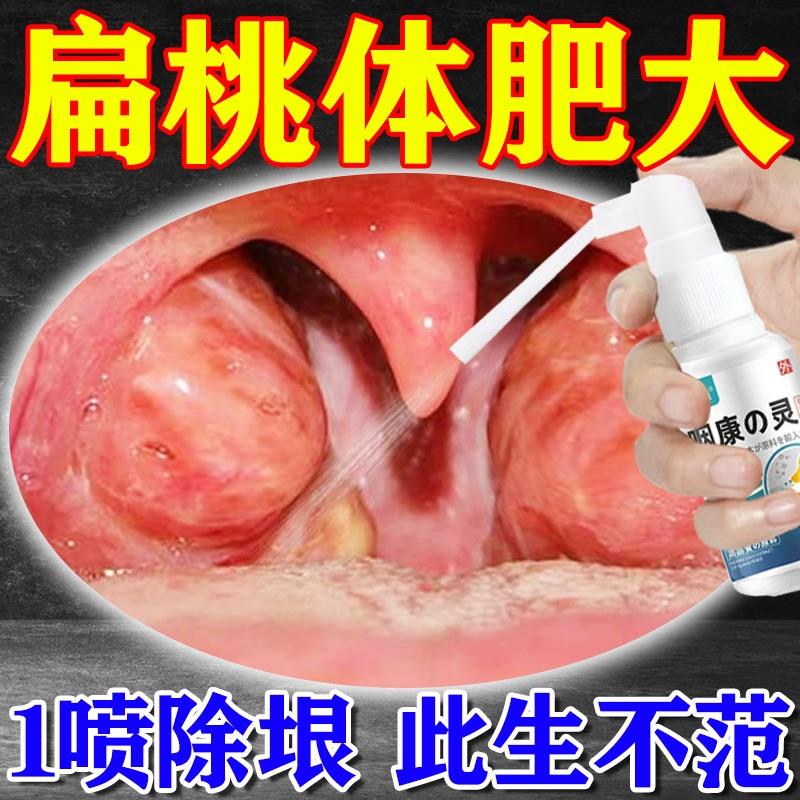 扁桃体肥大肿大贴打呼噜治疗咽喉咙肿痛发炎化脓儿童专用特效中药