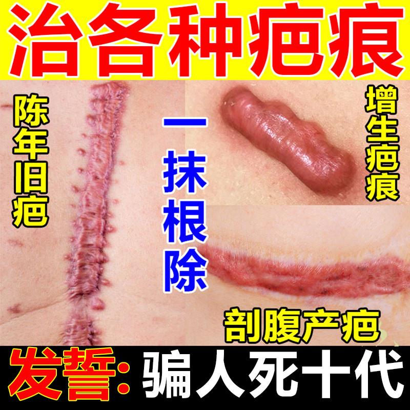 去除增生疤痕疙瘩凸起正品软化胸前瘢痕体质伤疤手术疤痕灵修复痒