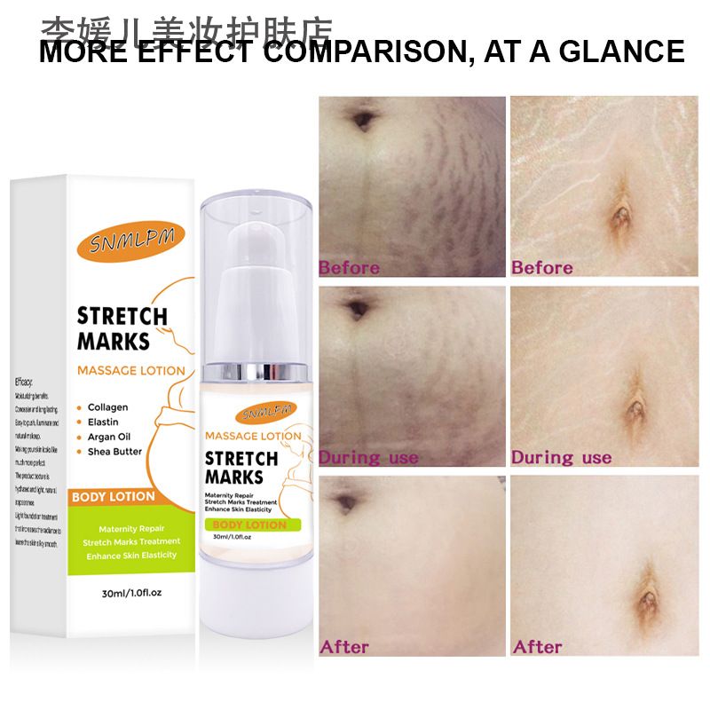 跨境产后肥胖生长纹孕身纹修护霜 stretch mark repair cream现货