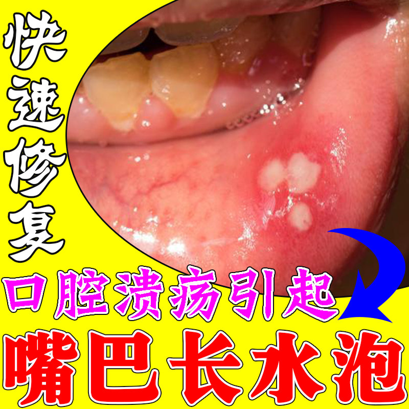 嘴巴舌头烂药治疗舌尖疼痛口疮起泡牙龈疼痛口腔溃疡专用喷雾喷剂
