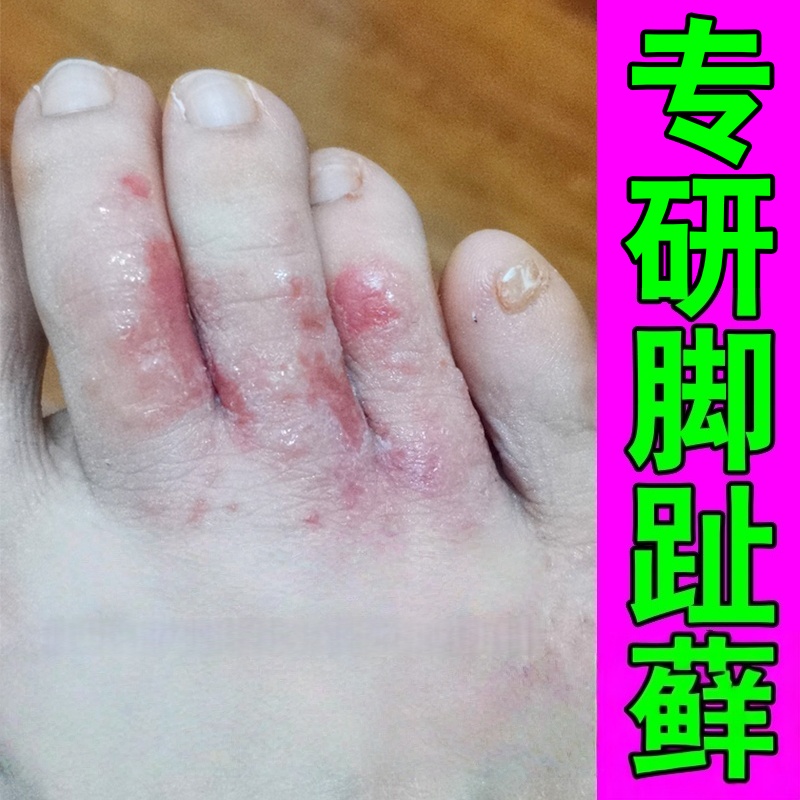 治脚趾头关节长藓痒脚背痒长红斑疙瘩起硬皮感染真菌溃烂掉皮干裂