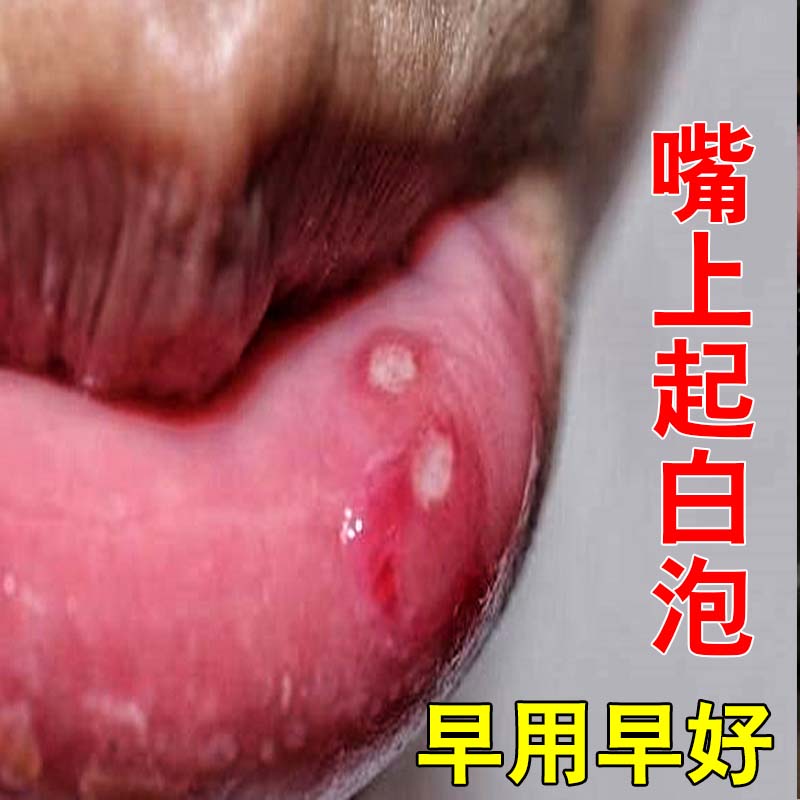 嘴唇起泡起水泡上火嘴巴上火起泡嘴唇疱疹清热口生疮口腔溃疡嘴烂