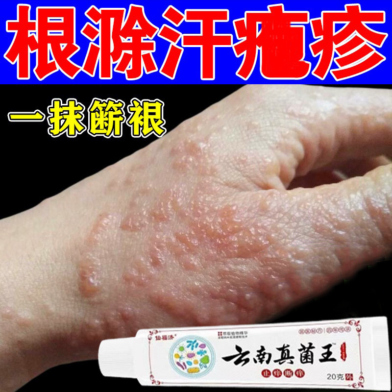 汗泡疱疹药膏治汗疱疹的药手足脱皮小水泡真菌感染鹅掌风特效乳膏