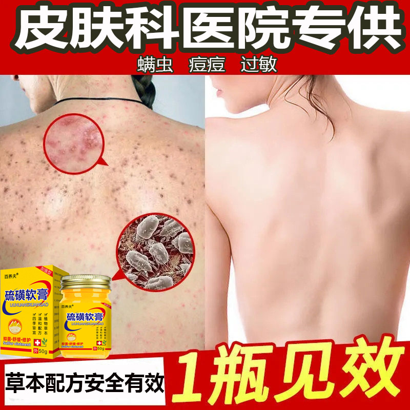 背上长痘痘后背药膏除螨虫神器