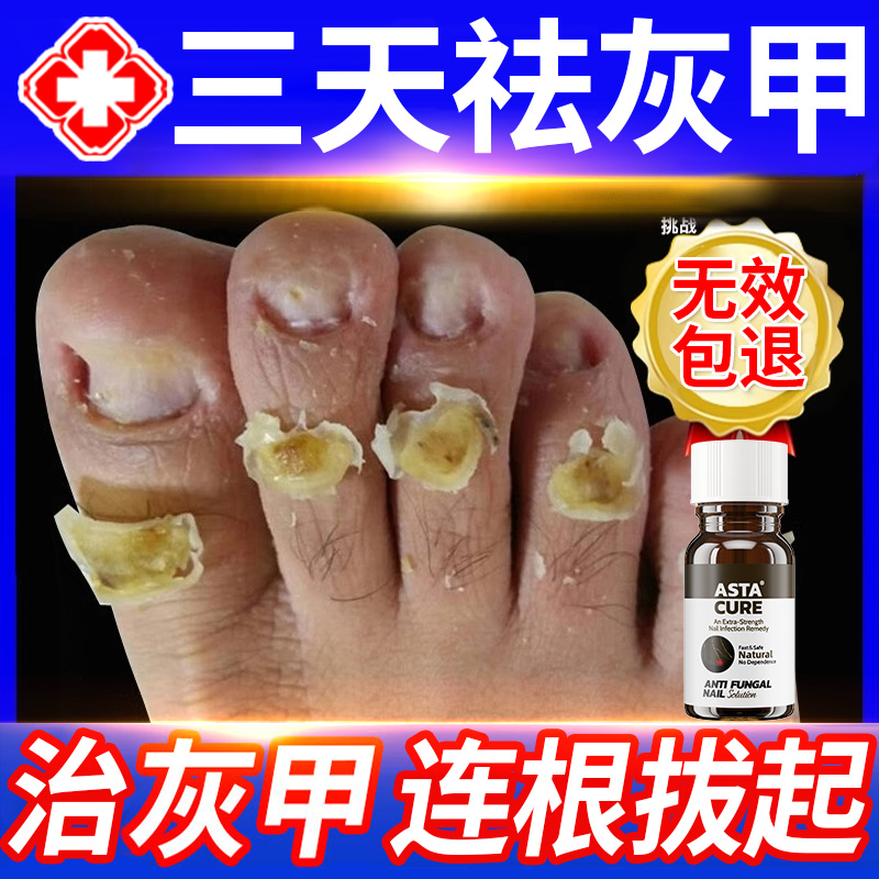 灰指甲专用药灰指甲抑菌液第一名正品旗舰店阿莫罗芬搽剂亮甲进口