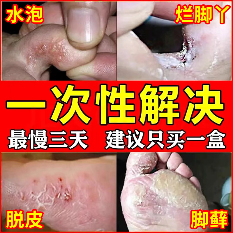 【自营】脚气药膏烂脚丫药脱皮糜烂脚趾去根专用的特效药喷雾止痒