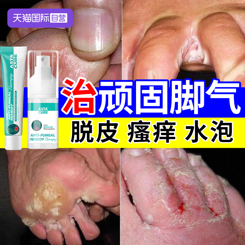 【自营】脚气止痒脱皮杀菌去根专用特效药脚痒水泡烂脚丫喷雾真菌