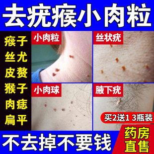 【自营】去疣瘊小肉粒扁平疣去除膏去除软膏疣瘊液氮冷冻液鸡眼贴