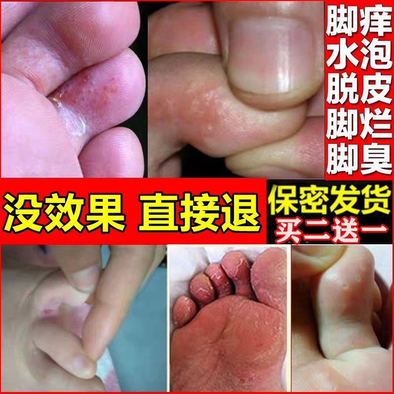 云南黄金百草足部脚痒脱皮