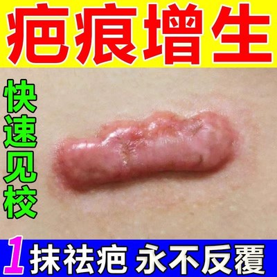 疤痕灵疙瘩胸前增生凹凸起软化修复膏去除去伤疤痕贴耳洞刀疤药膏