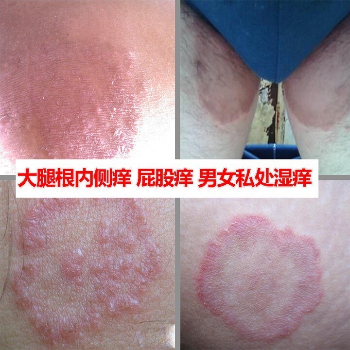 皮康王大腿内侧体股廯痒灵专用阴囊皮肤肛门瘙骚痒止痒净膏