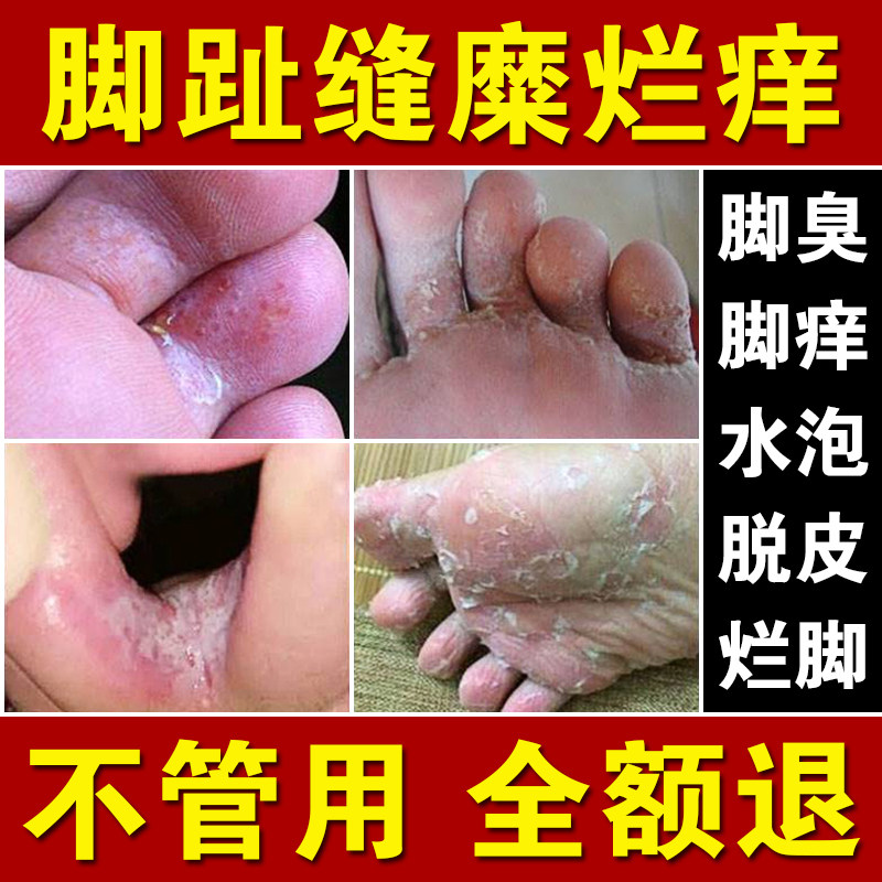 烂脚丫水泡脚脱皮治气疗糜烂根专特去脚趾缝烂痒傚藥杀菌用止痒膏
