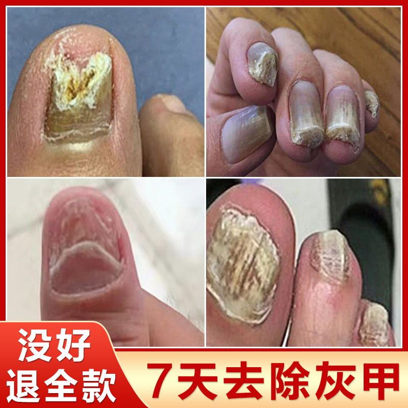 去除增厚发黄黑白空甲修复菌抑液亮手指灰甲神器脱坏脚趾甲变好膏