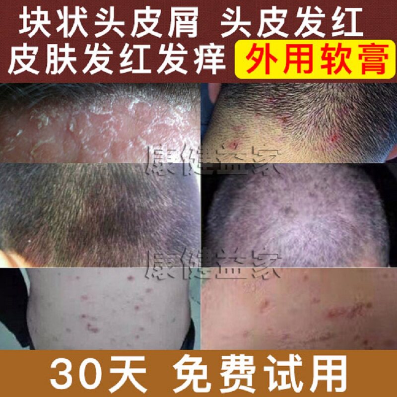 头部手足皮肤痒外用去大块头皮屑去屑止痒正品老偏方黑豆馏油软膏