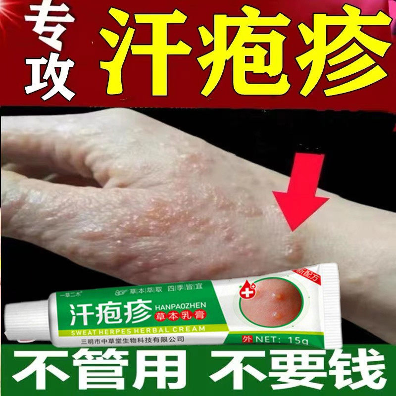 手上起小水泡汗泡疱止中抑药菌鹅掌风真菌感染痒手气湿痒疹专用膏