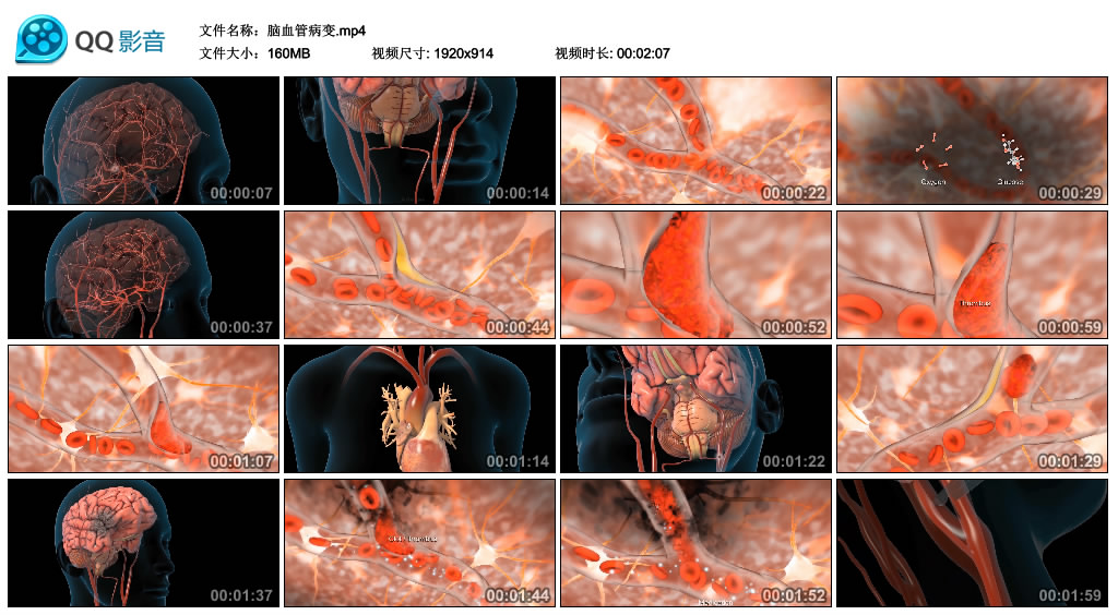 064 3D 三维心脑血管病中风医疗视频高清素材 血管堵塞素材