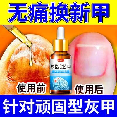 凤仙花灰指甲抑菌液旗舰店亮甲专用脱甲膏正品官方修脚刀真菌感染