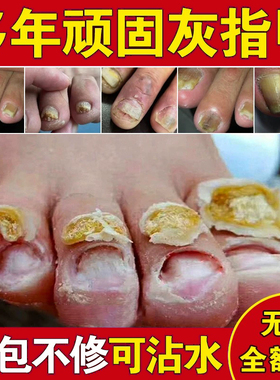 灰指甲药水特效专用凤仙花抑菌液亮甲真菌感染脱甲膏正品修甲刀剪