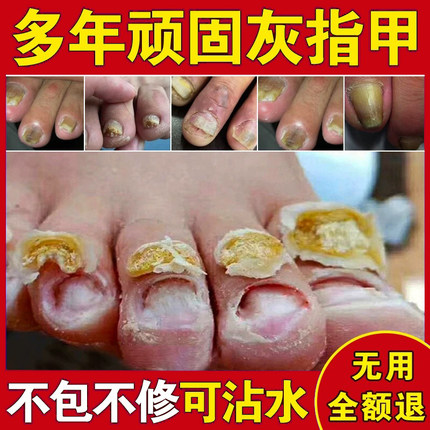 灰指甲药水专用凤仙花抑菌液亮甲真菌感染脱甲膏正品修甲刀剪