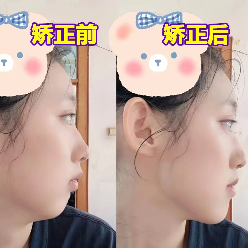 日本张嘴口矫正儿童张嘴睡觉凸嘴腺样本面容口轮匝肌唇训练矫正器