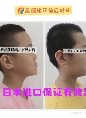 牙齿矫正器儿童牙套隐形夜间磨牙龅牙地包天纠正不齐整牙神器日本