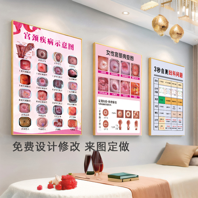 宫颈疾病示意图妇科挂画女解剖图