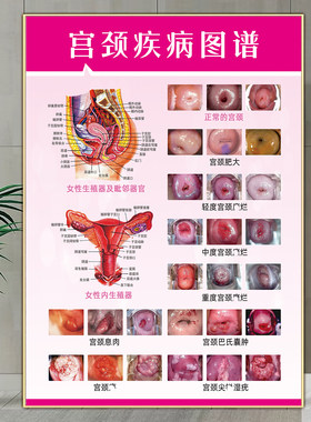 宫颈疾病示意图妇科广告挂画病变
