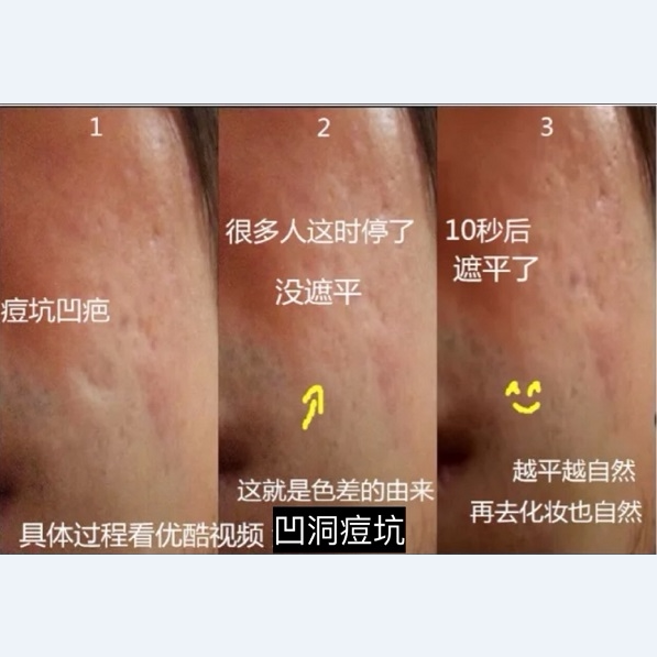遮痘坑痘印填凹洞遮瑕膏笔痘痘凹疤痕遮盖毛孔贴男女脸部持久神器