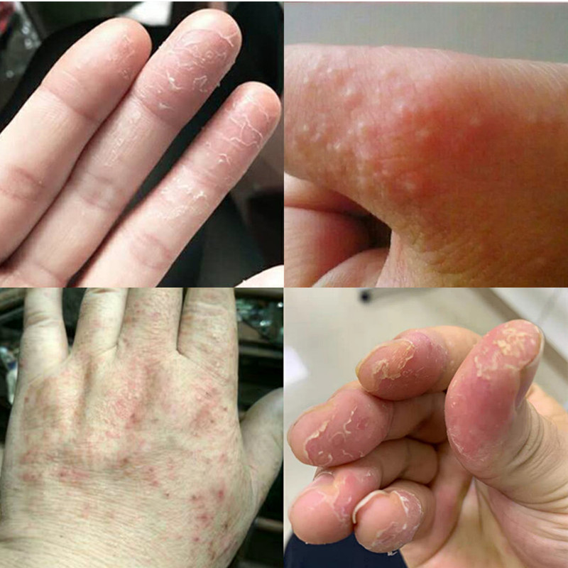 手脱皮季节性修复霜手掌手指头蜕皮开裂干裂维生素手起皮掉皮爆皮