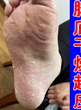 脚底干燥起皮掉屑外用修复药脚掌粗糙起干皮硬皮手足脱皮专用软膏