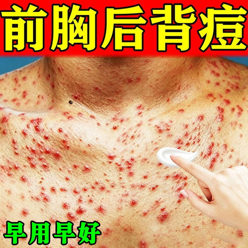 前胸后背长痘痘毛囊痒药胸口痘皮肤发红发痒长小红点疙瘩专用软膏